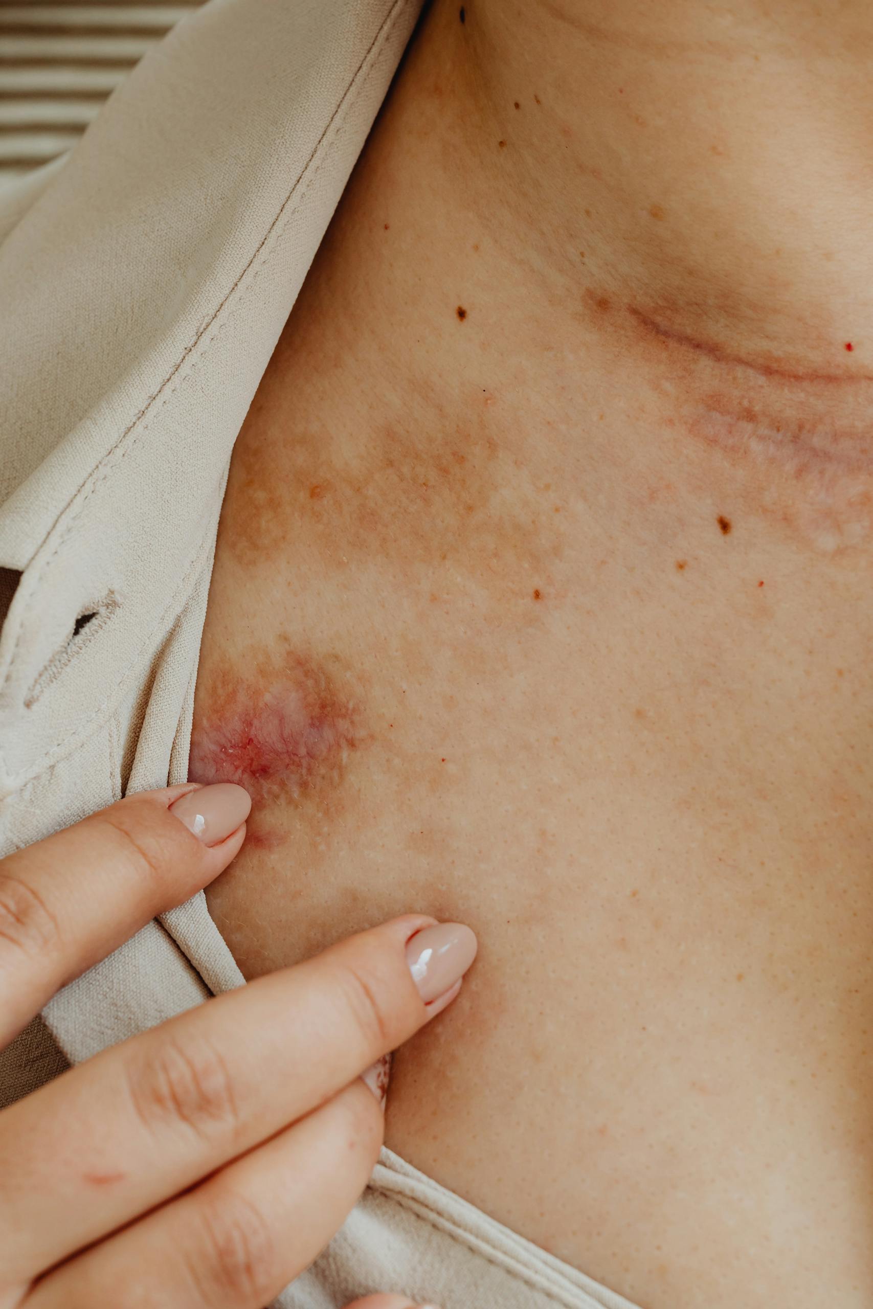 Detailed close-up of a bruise and injury mark on the skin, highlighting texture and healing.
